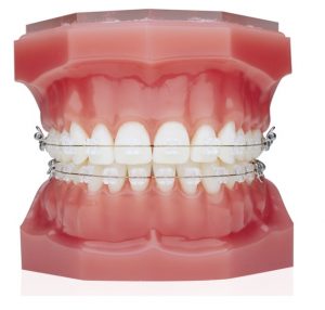 Ceramic-braces-treatment-vadodara