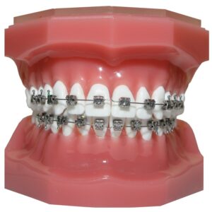 Orthodontic-metal-braces 