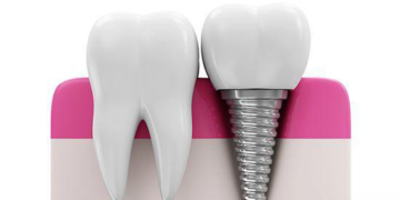 Lost your Teeth ? Planning for Dental Implants