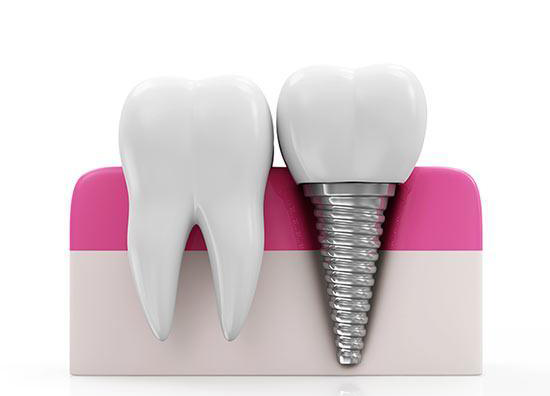 dental-implants-india