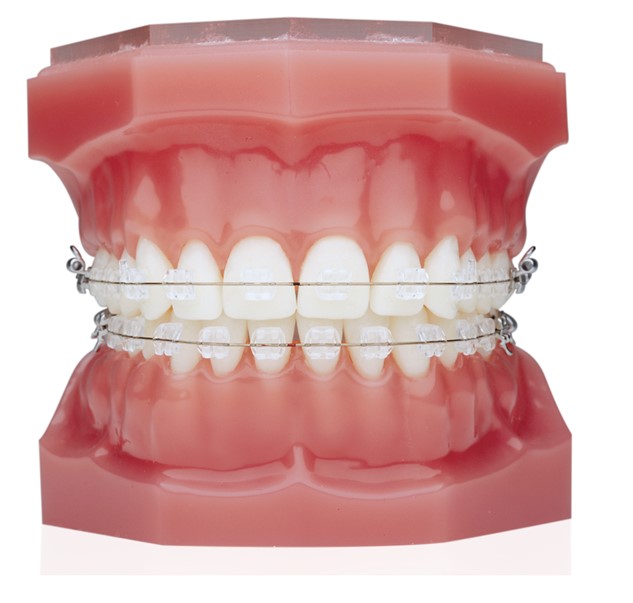 Ceramicbracestreatmentvadodara Dental Spa Vadodara
