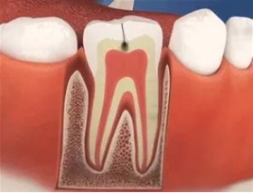 root-canal-treatment-in-vadodara