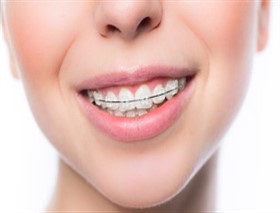 teeth-ceramic-braces
