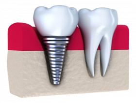 Dental Implants