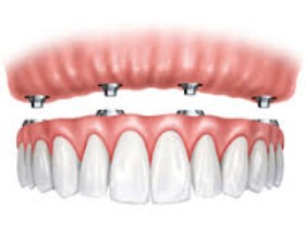 full-mouth-reconstruction-vadodara