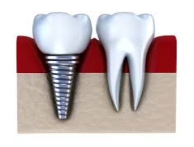 dental-implant-treatment-in-vadodara