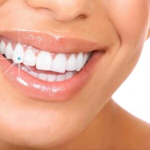 Bridal Dental Package – Sparkling Smile