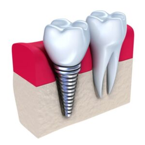 Dental Implant