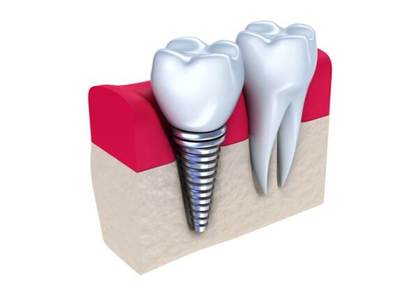 Dental-Implant-baroda