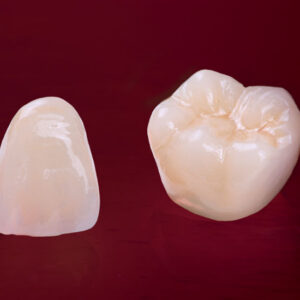 tooth-crown-capping-vadodara