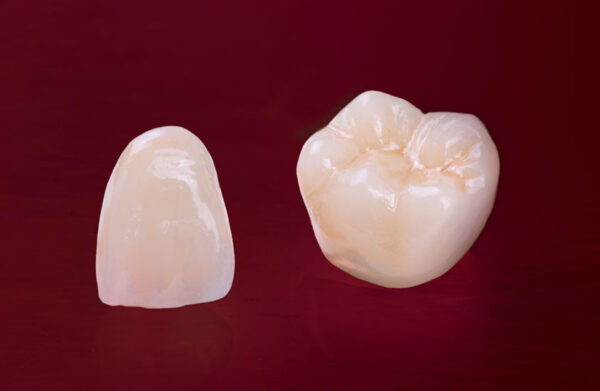 tooth-crown-capping-vadodara