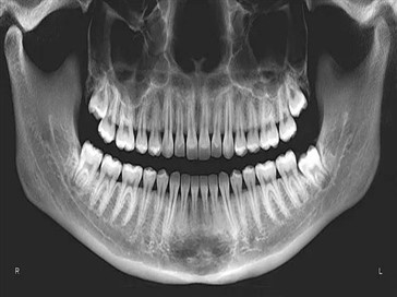 x-ray